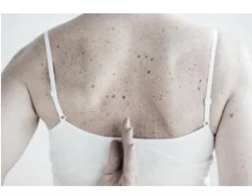 Удаление пигментации